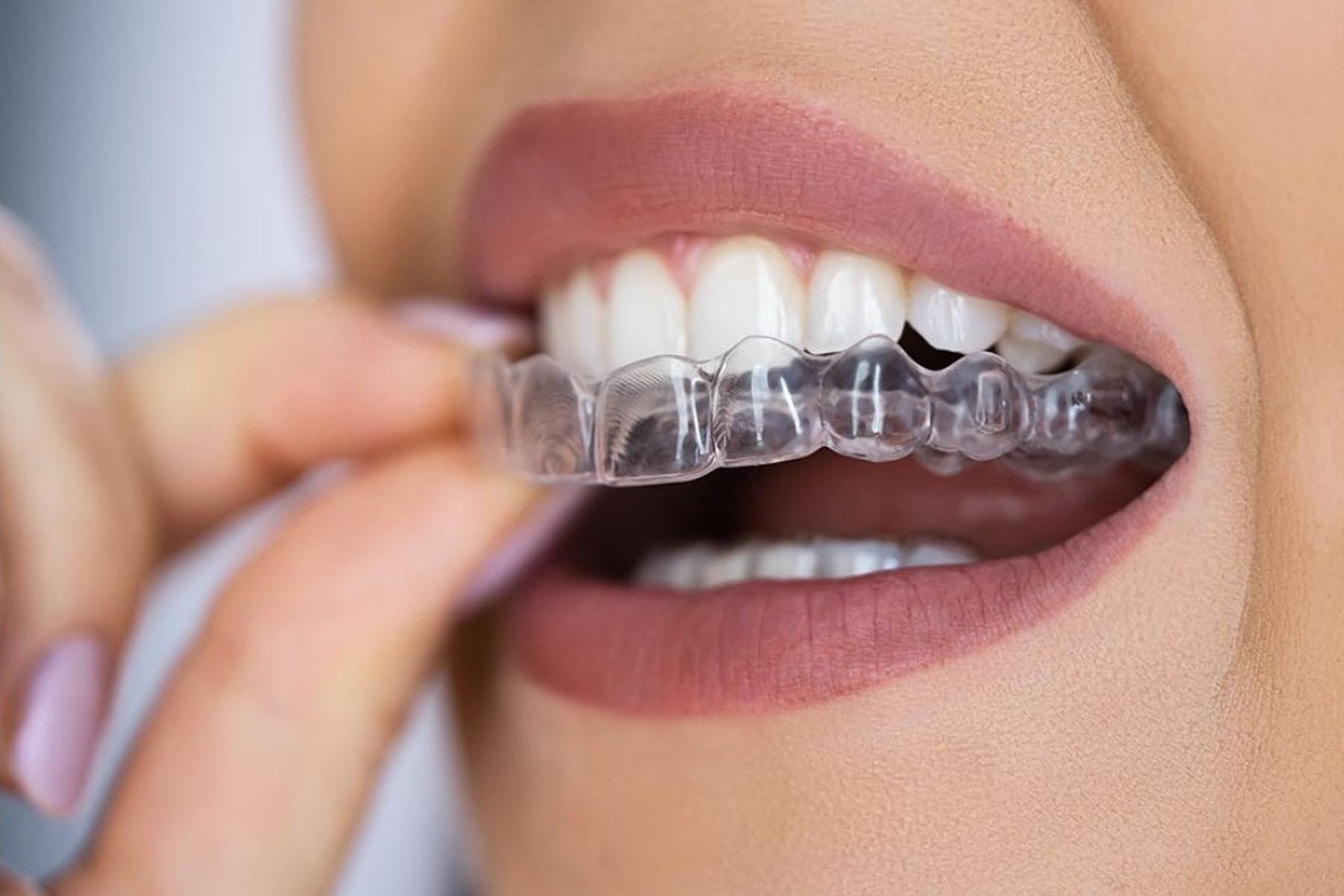 Why Invisalign May Be Your Best Option